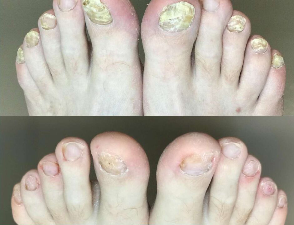 Before and after treatment, fungus promised cream