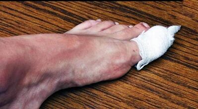 Compresses to treat the fungus on the thumb of the leg