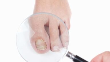 How to treat a fungus on the thumb