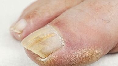 The reasons for the appearance of the fungus on the thumb