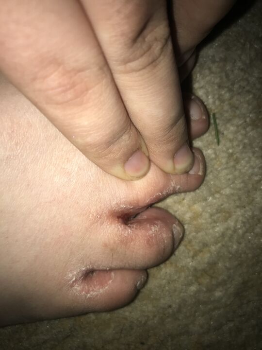 fungal toe infection