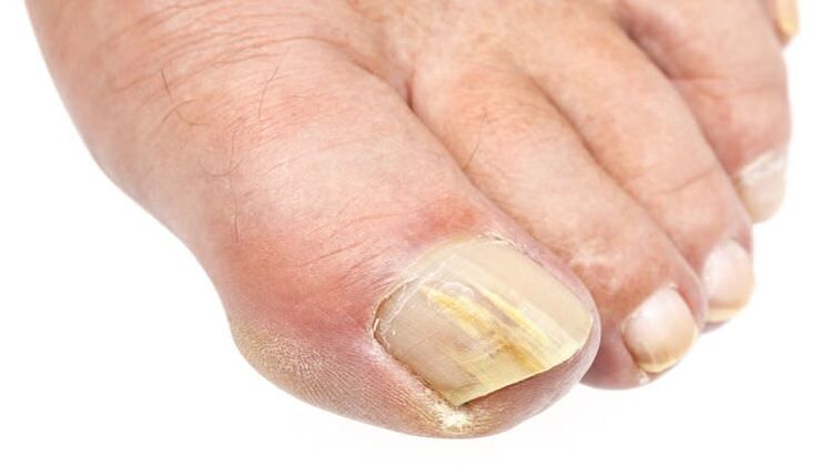 External change on the nail is a sign of fungal infection.