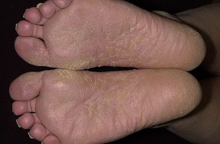 Dry, scaly skin on the feet is a sign of squamous mycosis