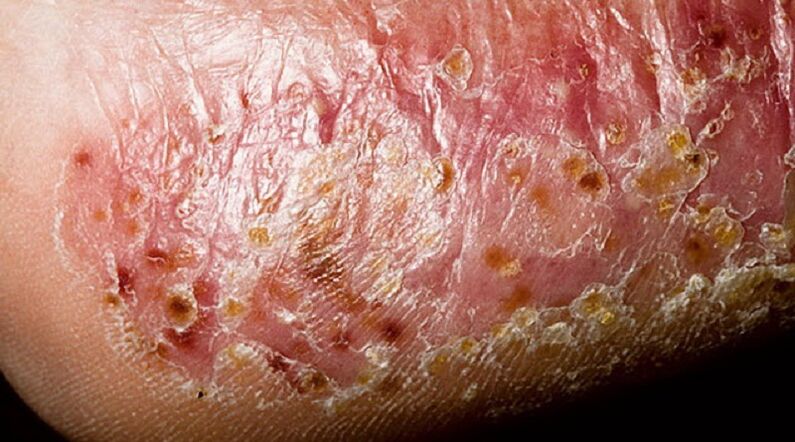 Dyshidrotic fungus on the feet