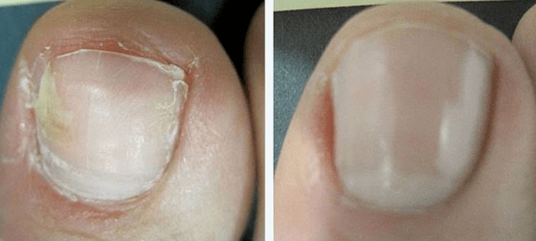 Nails before and after fungal treatment.