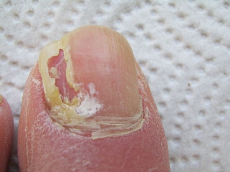 With onychomycosis, deformation of the nail plate occurs.